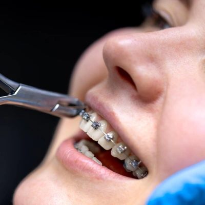 Patient getting teeth alignment with advanced orthodontic braces